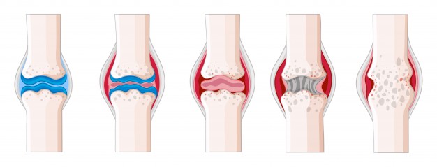 tratamiento fisioterapia artritis reumatoide