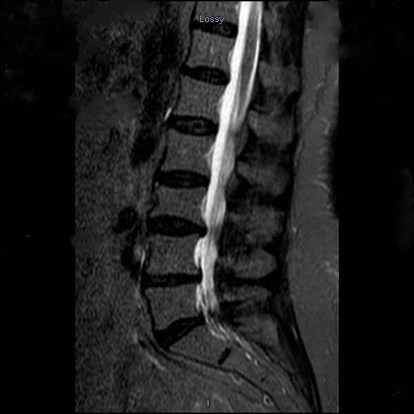 RM de columna lumbar en plano sagital evidenciando hernias discales y protrusiones tratadas mediante láser combinada bioestimulante para la disminución del dolor.