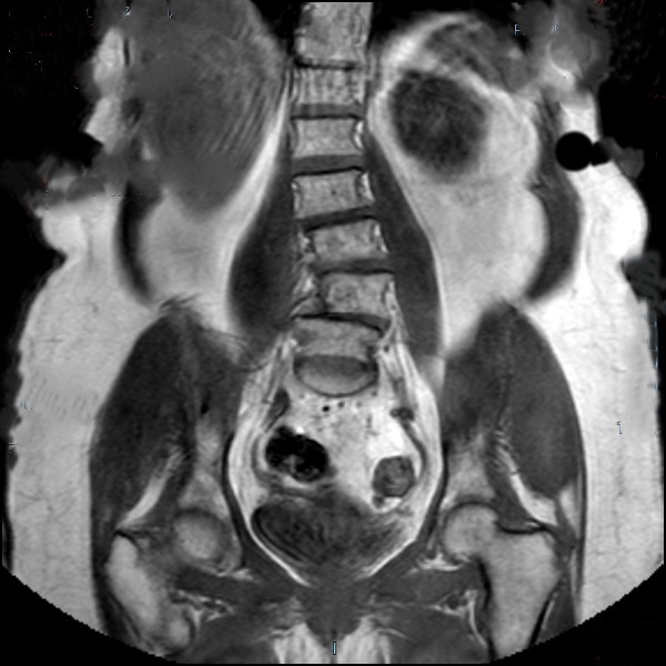 Resonancia magnética de columna lumbar en plano coronal que muestra una actitud escoliótica y cambios degenerativos óseos en paciente tratada con bioestimulación láser.