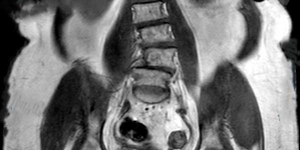 Resonancia magnética de columna lumbar en plano coronal que muestra una actitud escoliótica y cambios degenerativos óseos en paciente tratada con bioestimulación láser.