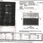 Densitometria osea posterior al tratamiento en paciente con osteopenia.