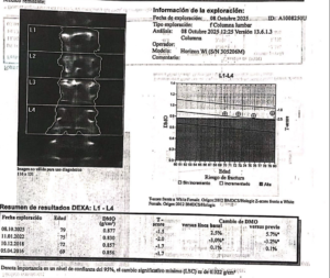 Densitometria osea posterior al tratamiento en paciente con osteopenia.