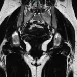 Imagen de resonancia de cadera mostrando inflamación de la bursa serosa y calcificaciones antes del tratamiento láser.
