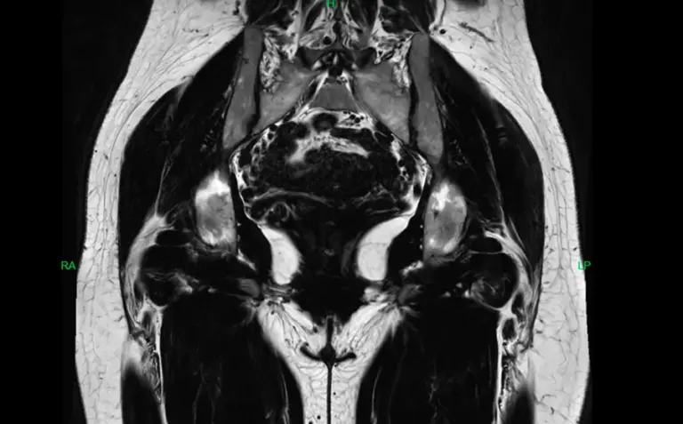 Imagen de resonancia de cadera mostrando inflamación de la bursa serosa y calcificaciones antes del tratamiento láser.