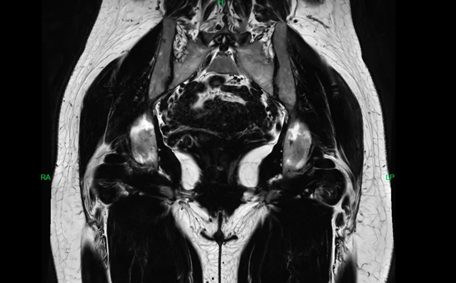 Imagen de resonancia de cadera mostrando inflamación de la bursa serosa y calcificaciones antes del tratamiento láser.