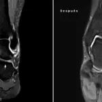 Imagen del antes y después del tratamiento con fisioterapia láser de un desgarro de ligamento con edema óseo en un tobillo.
