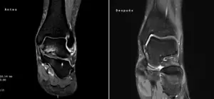 Imagen del antes y después del tratamiento con fisioterapia láser de un desgarro de ligamento con edema óseo en un tobillo.
